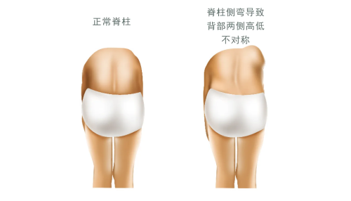 脊柱侧弯对比图