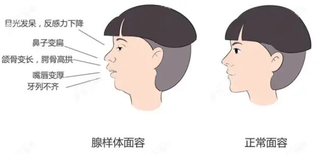 腺样体面容