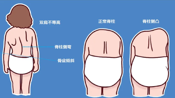 脊柱侧弯体征
