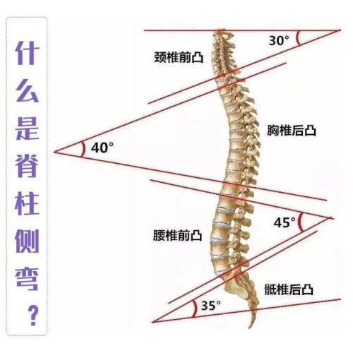 脊柱侧弯