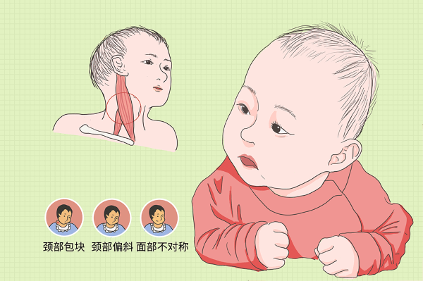 斜颈症状