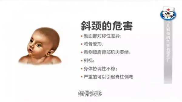 斜颈危害