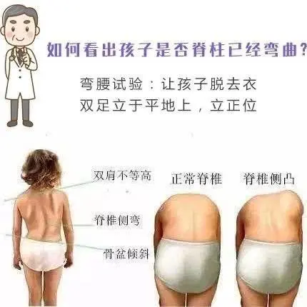 怎么看脊柱弯曲