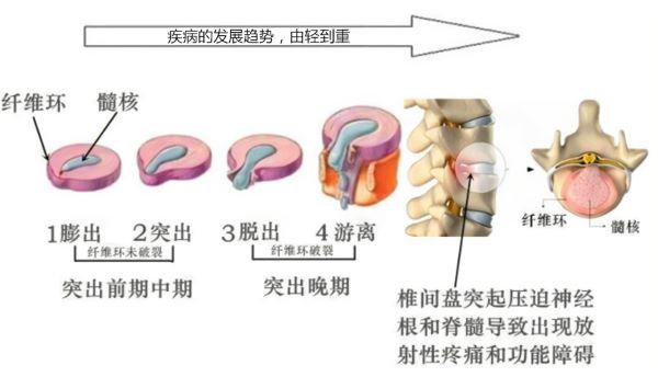 椎间盘突出疾病发展