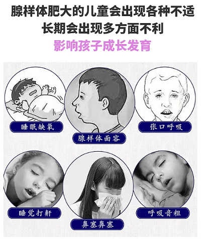 腺样体肥大症状