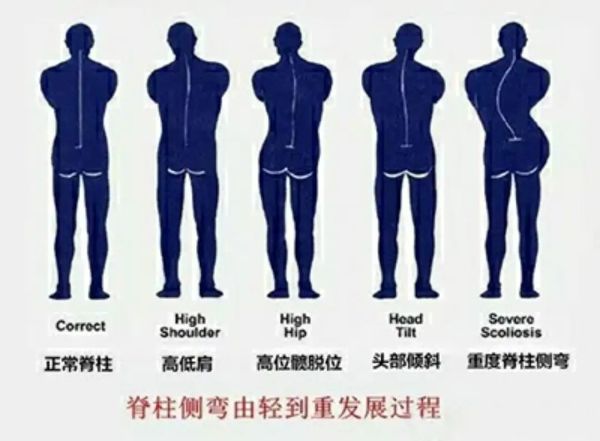 脊柱侧弯轻重发展过程