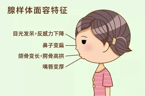 腺样体面容特征