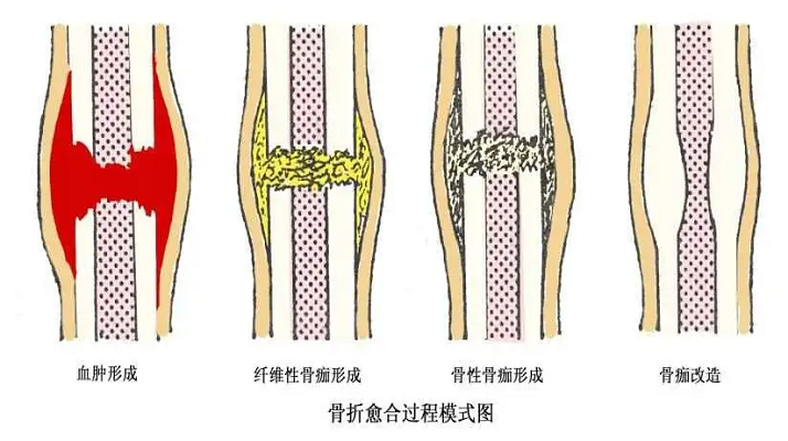 骨折愈合